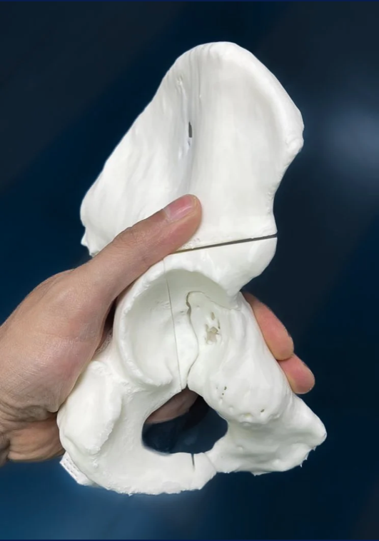 Plan e impresión 3D en condrosarcoma de pelvis